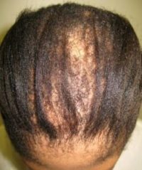 Hair Loss, Black Women, Afro Hair, Hair Salon, Kensington