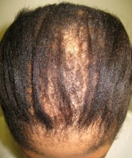 Advice For Women With Thinning Afro hair